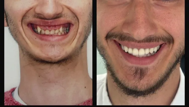 Reabilitare estetică: zâmbetul unui pacient tânăr înainte și după tratament.