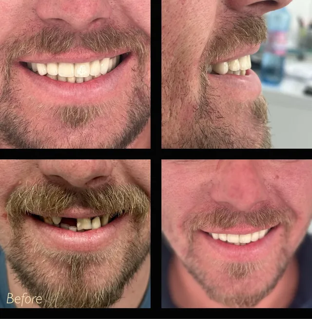 Reabilitare orală: zâmbetul unui pacient înainte de tratament, cu dinți lipsă, și după.