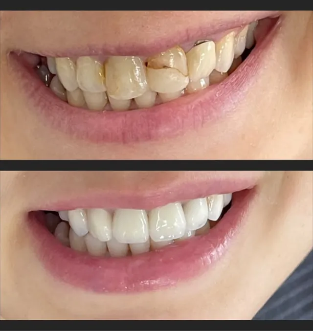 Reabilitare estetică: zâmbetul unei paciente înainte (sus) și după tratament (jos).