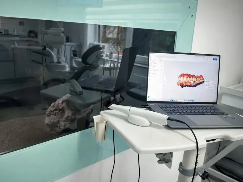 Scanerul intraoral, în suportul de pe cărucior, lângă laptopul pe care se vede modelul 3D al dinților.
